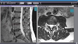 Toxic MRI Gadolinium Contrast Agent Causing Debilitating Diseases In Patients [upl. by Witt]