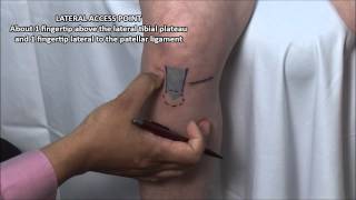 Knee Injection  Anterior Approach [upl. by Gide]