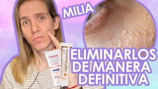 TRATAMIENTO de QUISTES DE MILLIUM o MILIA ¿Cómo eliminarlos Tratamiento Dermatologico [upl. by Nossila]